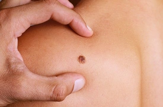 Dermatology