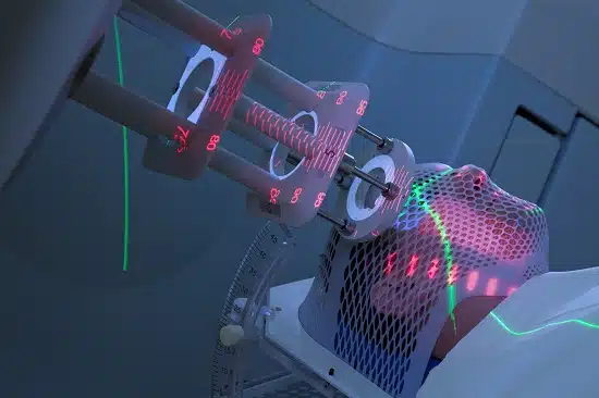 Radiotherapy